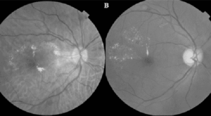 Brolucizumab dalam Tata Laksana Diabetic Macular Edema (DME)