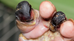 Mempertimbangkan Amputasi atau Tidak pada Kaki Diabetes