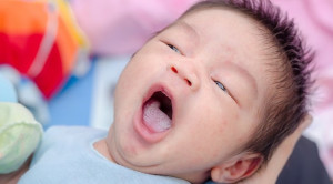 Kandidiasis Oral pada Bayi