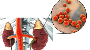Durasi Penggunaan Antibiotik pada Pielonefritis Akut