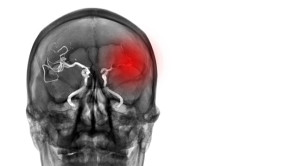Penanganan Awal pada Stroke Iskemik Akut