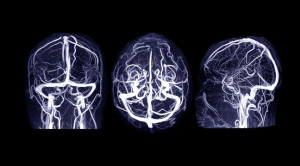 Trombektomi Endovaskular Sebagai Terapi Stroke Iskemik Akut