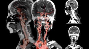 Identifikasi Faktor Risiko Contrast-Induced Acute Kidney Injury (CI-AKI)