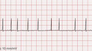 Perbandingan Efektivitas Dan Keamanan Jangka Panjang Antara Dabigatran, Rivaroxaban, Apixaban, dan Edoxaban Pada Pasien Atrial Fibrilasi: Studi Kohort Nasional – Telaah Jurnal Alomedika