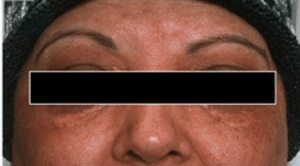 Terapi Laser pada Xanthelasma