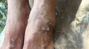 Manajemen Neurodermatitis pada Lansia