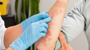 Tantangan Tata Laksana Psoriasis Vulgaris Sedang hingga Berat dengan Terapi Sistemik Konvensional