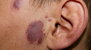 Skrining Keterlibatan Ekstrapulmoner Pada Pasien Sarkoidosis