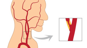 Tata Laksana Stenosis Arteri Karotis Asimtomatik
