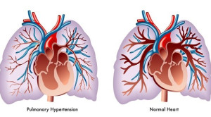 Uji Klinis Fase 3 Sotatercept Sebagai Terapi Hipertensi Arteri Pulmonal – Telaah Jurnal Alomedika