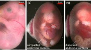Persalinan Pervaginam Aman untuk Fetus dengan Gastroschisis