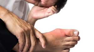 Kortikosteroid vs Obat Antiinflamasi Nonsteroid untuk Terapi Gout Arthritis Akut