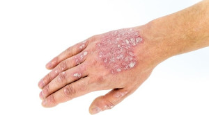 Terapi Oral untuk Psoriasis Vulgaris