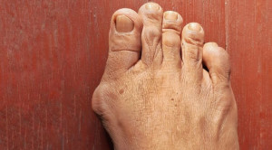 Perlu Tidaknya Pembedahan untuk Bunion