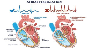 Pedoman Penanganan Atrial Fibrilasi ESC 2024 – Ulasan Guideline Terkini