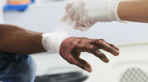 Antibiotik Oral untuk Mencegah Infeksi pada Luka Bakar