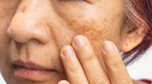 Efektivitas Berbagai Terapi Topikal pada Melasma