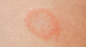Stop Memberikan Kortikosteroid untuk Dermatofitosis!