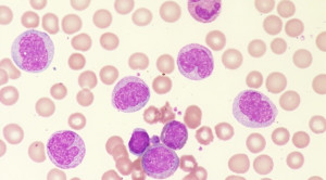 Leukositosis pada Polisitemia Vera
