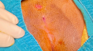 Terapi Endoskopik untuk Sinus Pilonidal