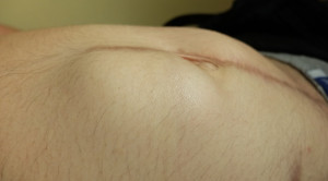Pencegahan Hernia Insisional Berbasis Bukti