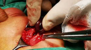 Pemilihan Waktu Operasi Undesensus Testis dan Risiko Kanker Testis