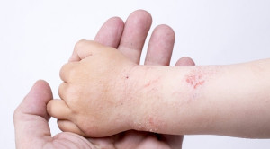 Pemahaman Terkini Patogenesis Dermatitis Atopik