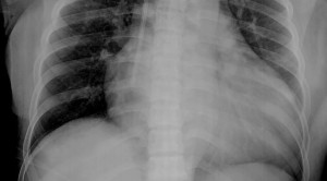 Pedoman Tata Laksana Gagal Jantung PERKI – Ulasan Guideline Terkini