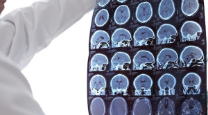 Pembaruan Kriteria McDonald untuk Multiple Sclerosis – Ulasan Guideline Terkini