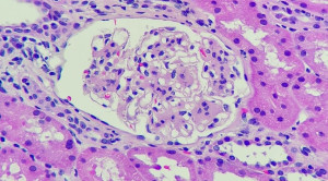 Efikasi dan Keamanan Felzartamab Untuk Nefropati IgA – Telaah Jurnal Alomedika