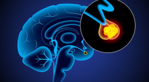 Pedoman Pembedahan pada Adenoma Hipofisis Fungsional – Ulasan Guideline Terkini
