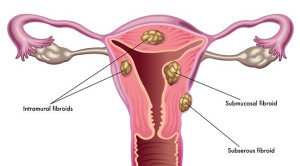 Disparitas Multidimensional dalam Pemanfaatan Uterine Fibroid Embolization pada Fibroid Uterus – Telaah Jurnal Alomedika