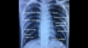 Interpretasi Rontgen Toraks