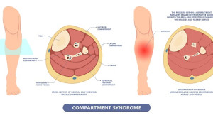 Pedoman Penanganan Sindrom Kompartemen Akut – Ulasan Guideline Terkini