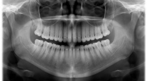 Dampak Negatif Rontgen Gigi – Telaah Jurnal Alomedika