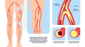 Kapan Memilih Aterektomi untuk Penyakit Arteri Perifer?