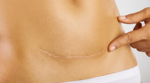 Suture Lebih Unggul dibandingkan Stapler pada Sectio Caesarean