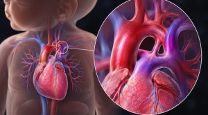 Terapi Konservatif vs Medikamentosa pada Patent Ductus Arteriosus Bayi Prematur – Telaah Jurnal Alomedika