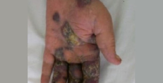 Manifestasi Penyakit Kulit pada Pasien HIV/AIDS