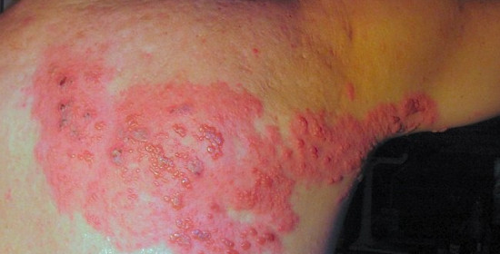 Opsi Analgesik untuk Nyeri Herpes