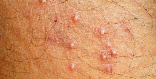 Terapi Topikal Vs Sistemik untuk Bisul atau Folikulitis Bakterial