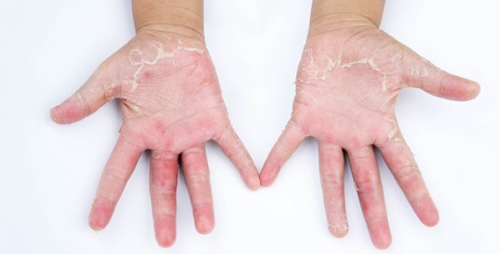 Membedakan Dermatitis Kontak Iritan dengan Dermatitis Kontak Alergi