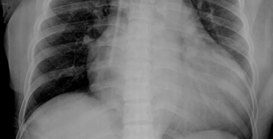 Pedoman Tata Laksana Gagal Jantung PERKI – Ulasan Guideline Terkini