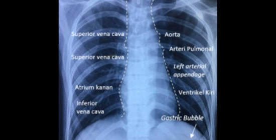 Interpretasi Rontgen Toraks