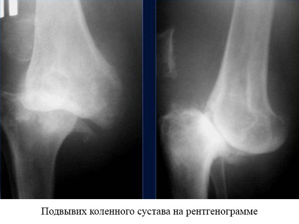 Смещение коленного сустава. Подвывих коленного сустава рентген. Подвывих смещение коленного сустава рентген. Вывих надколенника рентген. Смещение коленного сустава рентген.