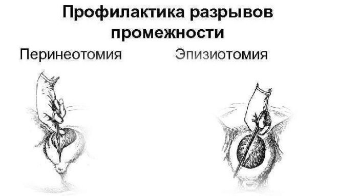 Перинеотомия и эпизиотомия презентация