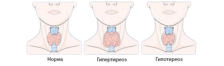 Гипертиреоз гипотиреоз презентация