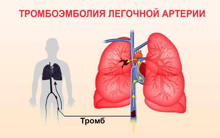 Тромбоэмболия это. Тромбоэмболия легочной артерии. Тромбоэмболия ветвей легочной артерии. Тромбоэмбол в легочной артерии. Тромбоэмболия в легочной артерии вызывает.