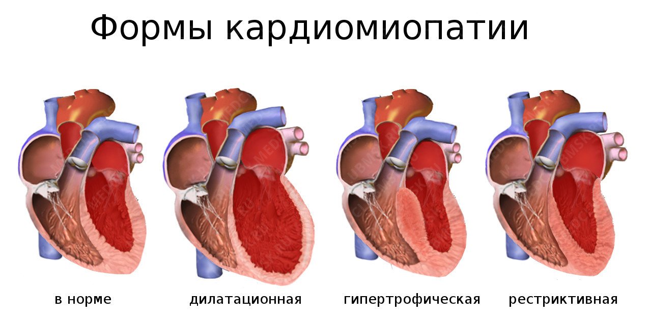 Дилатационная кардиомиопатия презентация