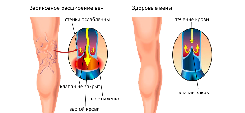 Варикозная болезнь вен нижних конечностей. Варикозное расширение вен нижних конечностей факторы. Варикозно расширенные вены ног.